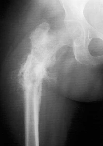 Osteosarcoma of the proximal femur, showing an aggressive bone tumor around the hip Osteosarcoma of the proximal femur, showing an aggressive bone tumor around the hip