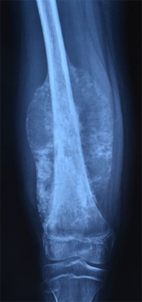 Osteosarcoma of the thigh bone (femur) Osteosarcoma of the thigh bone (femur)