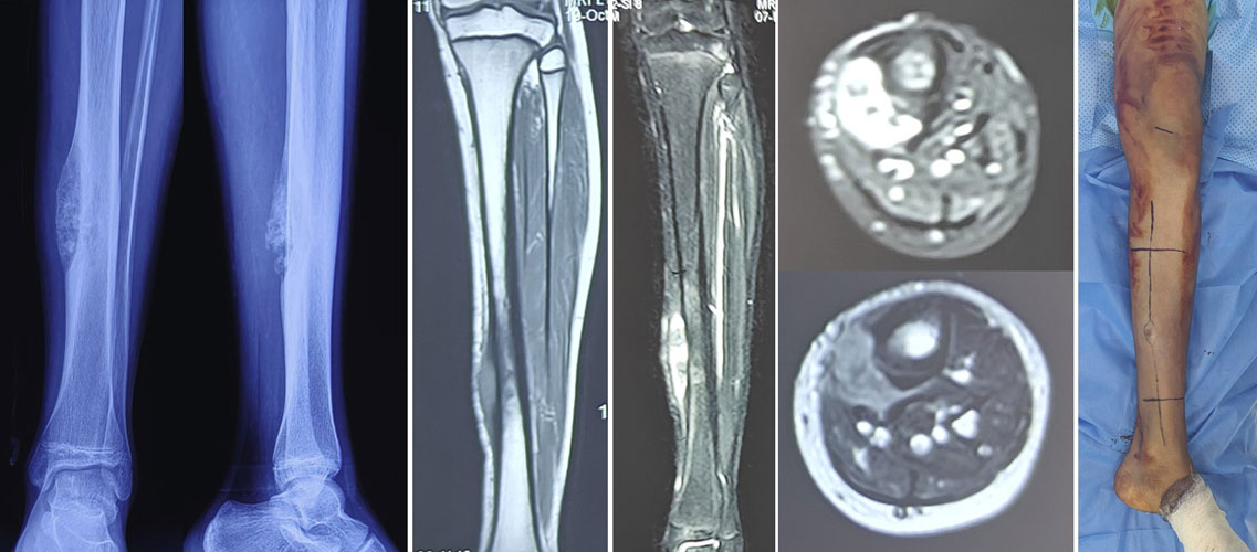 Osteosarcoma of the tibia (shin bone) shown on X-ray and MRI before treatment