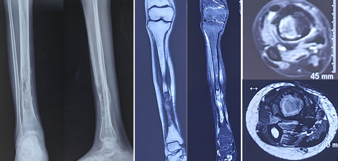 Osteosarcoma of the tibia showing the bone tumor and its extent on X-ray and MRI Osteosarcoma of the tibia showing the bone tumor and its extent on X-ray and MRI