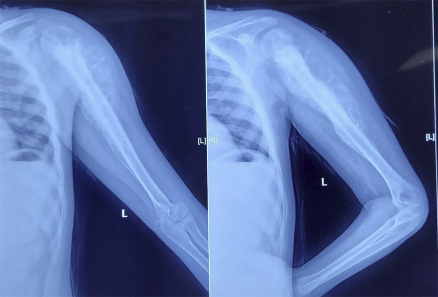 Osteosarcoma of the upper arm bone (humerus) Osteosarcoma of the upper arm bone (humerus)