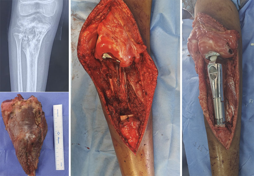 Osteosarcoma of the upper tibia treated with wide resection