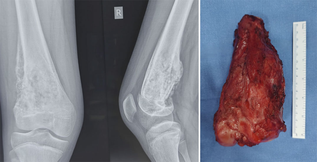 Osteosarcoma treated with limb-salvage surgery Osteosarcoma treated with limb-salvage surgery