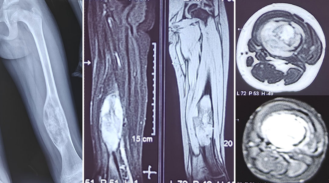 Osteosarcoma with preservation of the growth plates
