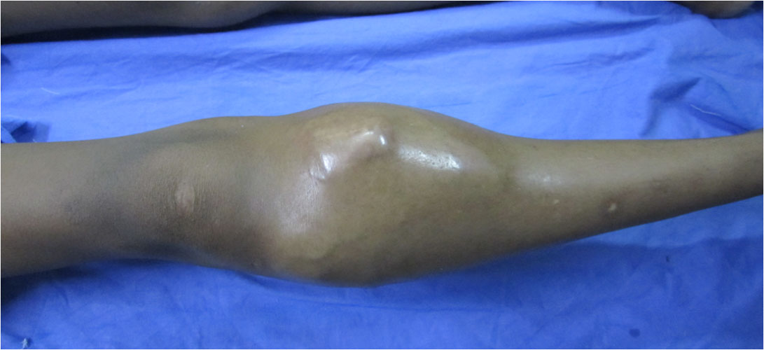 Painful swelling as a presentation of osteosarcoma Painful swelling as a presentation of osteosarcoma
