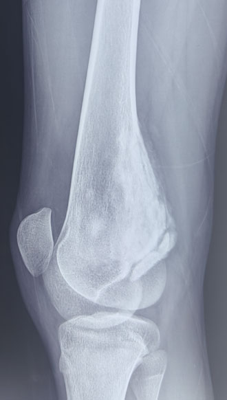 Parosteal osteosarcoma Parosteal osteosarcoma