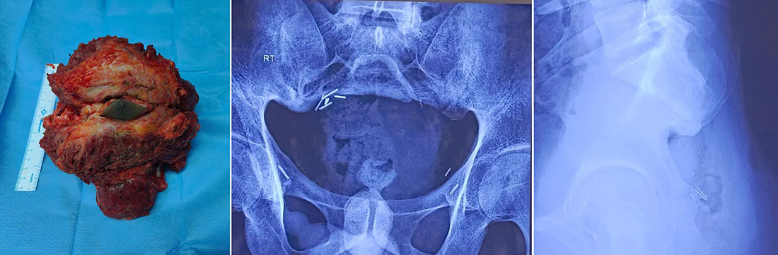 Partial sacrectomy for a sacral bone tumor Partial sacrectomy for a sacral bone tumor