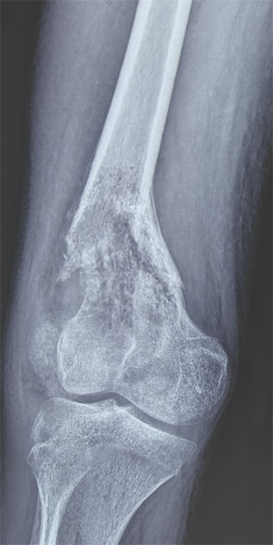 Pathological fracture due to osteosarcoma Pathological fracture due to osteosarcoma