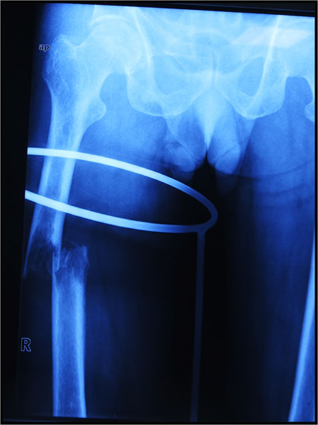 Pathological fracture of the thigh bone (femur) caused by metastatic lung cancer