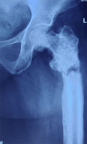 Pathological fracture of the thigh bone caused by cancer spread from the prostate Pathological fracture of the thigh bone caused by cancer spread from the prostate
