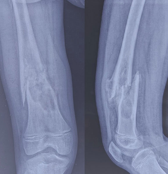 Pathological fractures can occur when a primary bone tumor weakens the bone Pathological fractures can occur when a primary bone tumor weakens the bone