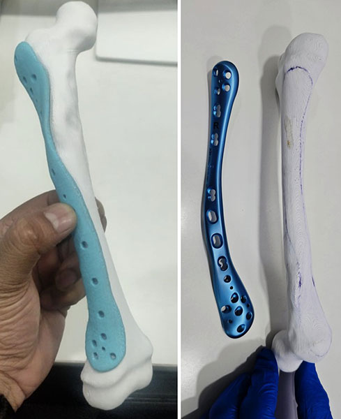 Patient-specific 3D planning and customized implants enable personalized reconstruction for complex bone tumors in children with deformed or fractured bones Patient-specific 3D planning and customized implants enable personalized reconstruction for complex bone tumors in children with deformed or fractured bones