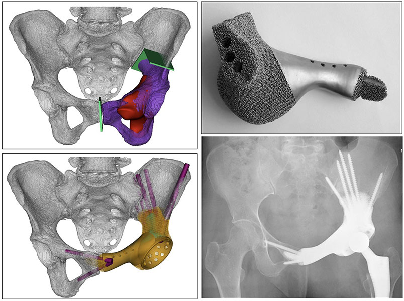 Patient-specific 3D-printed pelvic implant designed for reconstruction after pelvic bone tumor removal Patient-specific 3D-printed pelvic implant designed for reconstruction after pelvic bone tumor removal