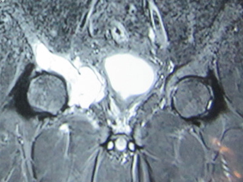 Pelvic bone tumor involving the hip joint, requiring more extensive resection and reconstruction Pelvic bone tumor involving the hip joint, requiring more extensive resection and reconstruction