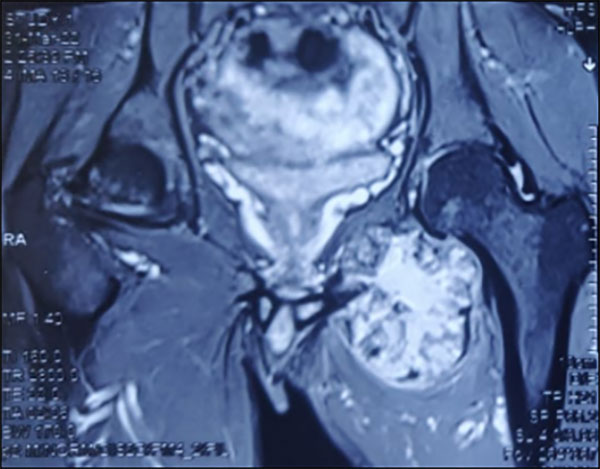 Pelvic bone tumor with the hip joint spared, allowing preservation of the natural hip during tumor surgery Pelvic bone tumor with the hip joint spared, allowing preservation of the natural hip during tumor surgery