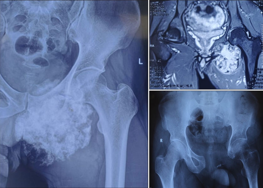 Pelvic chondrosarcoma treated with wide surgical resection Pelvic chondrosarcoma treated with wide surgical resection