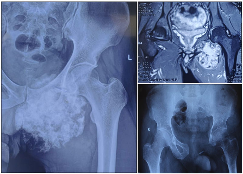 Pelvic tumor resection while preserving the hip joint, an important limb-salvage approach Pelvic tumor resection while preserving the hip joint, an important limb-salvage approach