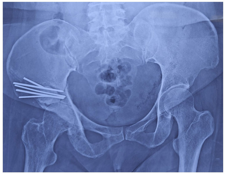 Periacetabular bone metastasis reconstructed with bone cement to restore structural stability Periacetabular bone metastasis reconstructed with bone cement to restore structural stability