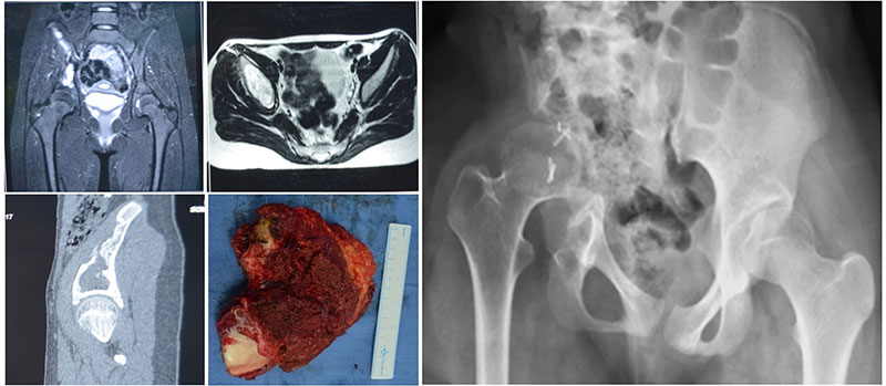 Periacetabular tumor resection with reconstruction of the hip and pelvic region Periacetabular tumor resection with reconstruction of the hip and pelvic region