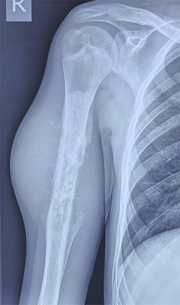 Periosteal osteosarcoma Periosteal osteosarcoma