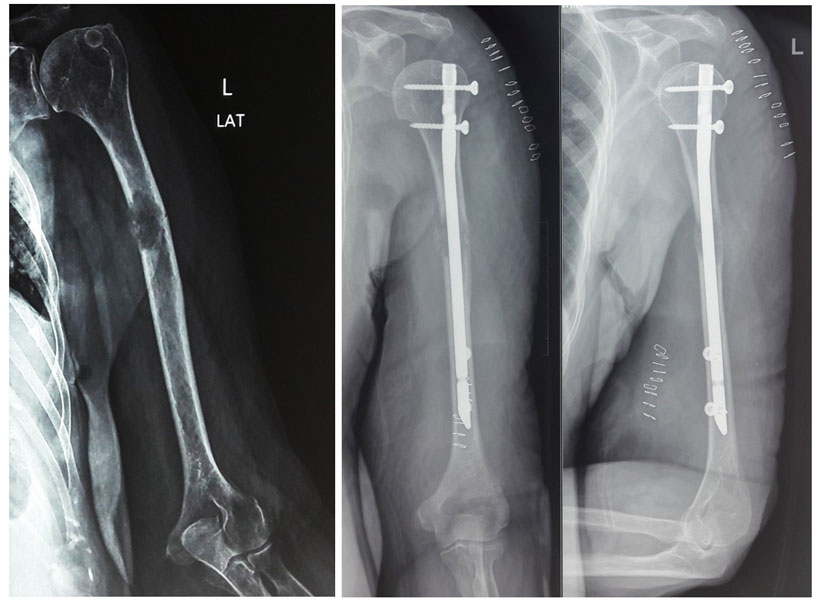 Preventive fixation of a bone weakened by metastatic cancer to prevent a pathological fracture Preventive fixation of a bone weakened by metastatic cancer to prevent a pathological fracture