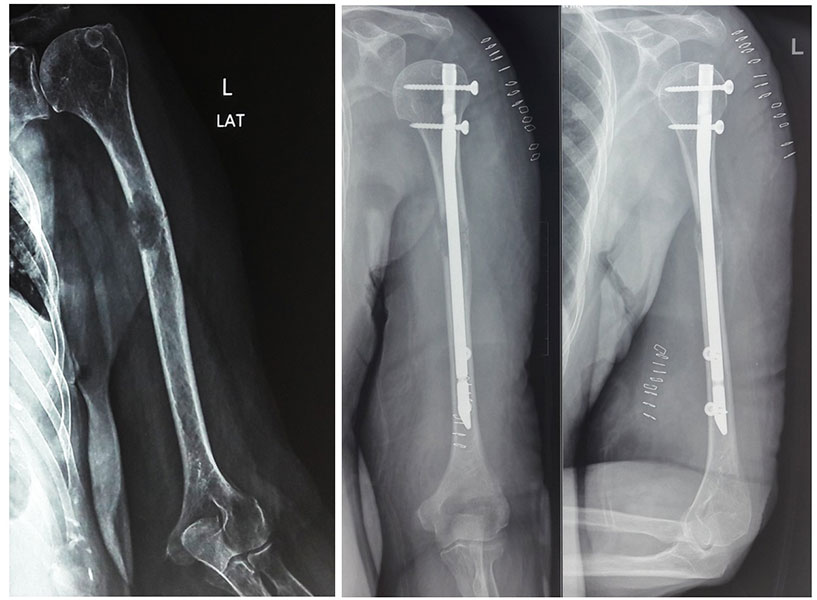 Preventive fixation of a weakened bone can stop an impending pathological fracture Preventive fixation of a weakened bone can stop an impending pathological fracture