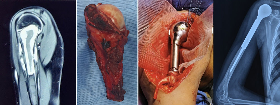 Proximal Humerus Megaprosthesis After Limb Salvage Proximal Humerus Megaprosthesis After Limb Salvage