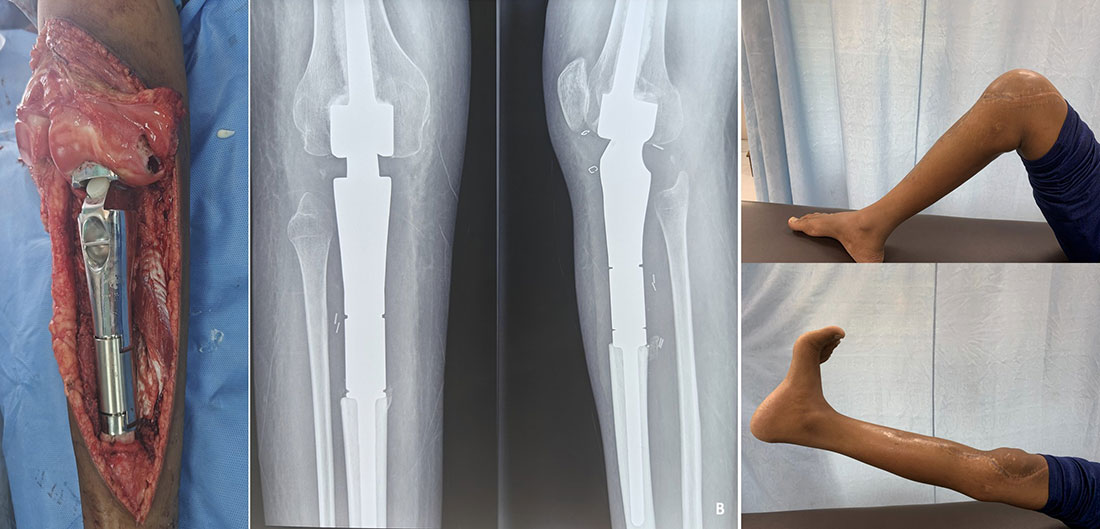 Proximal Tibia Megaprosthesis After Limb Salvage Proximal Tibia Megaprosthesis After Limb Salvage