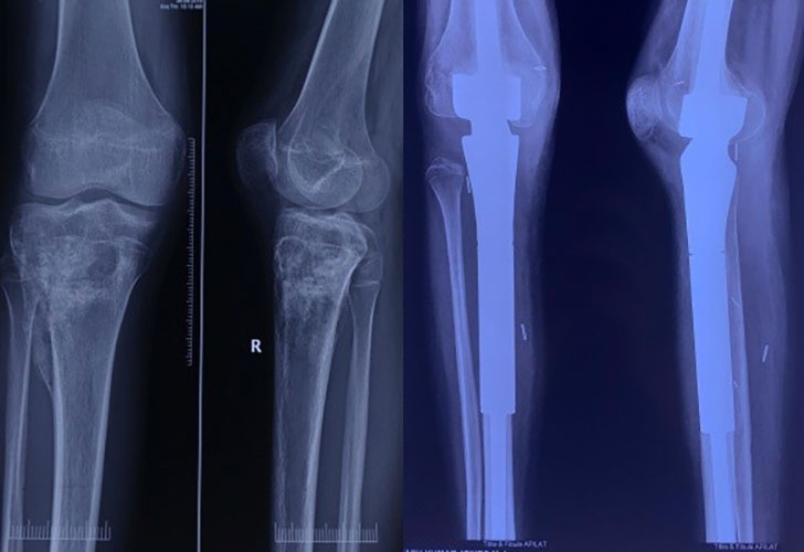 Proximal Tibia Tumor Reconstruction Proximal Tibia Tumor Reconstruction