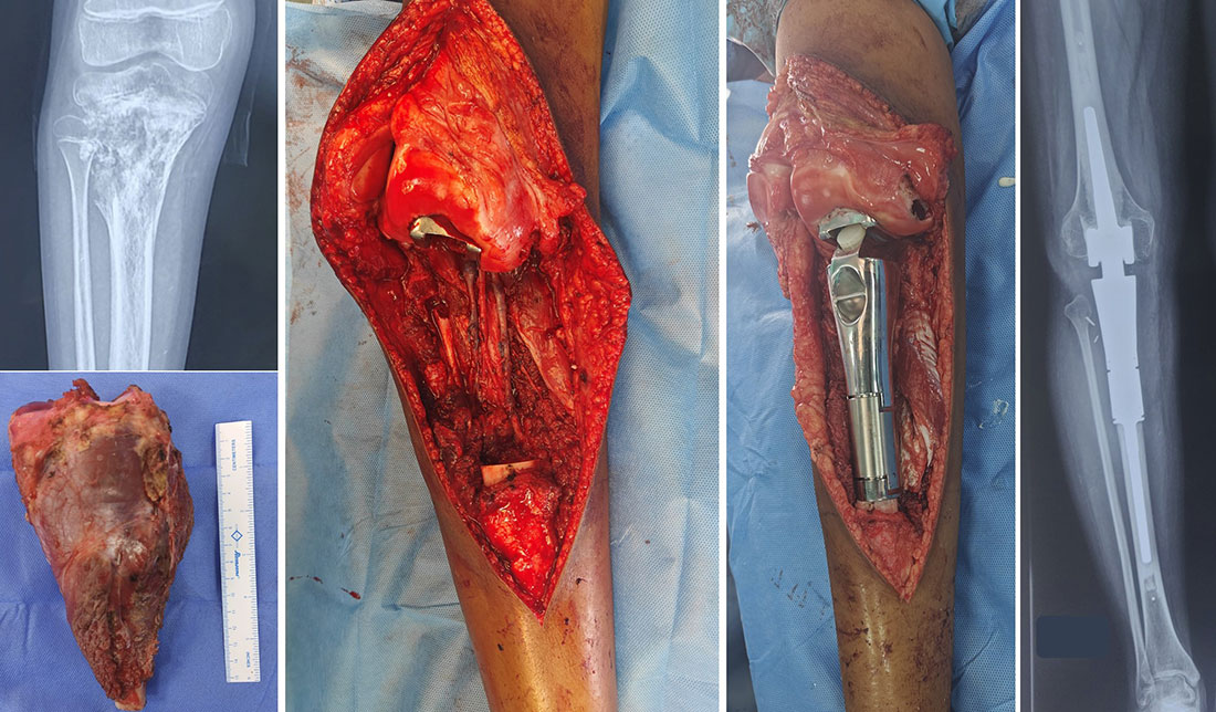 Proximal Tibia Tumor – Limb-Salvage Reconstruction Proximal Tibia Tumor – Limb-Salvage Reconstruction