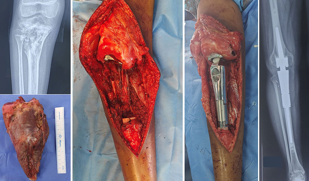 Proximal Tibia Tumor – Limb-Salvage Reconstruction Proximal Tibia Tumor – Limb-Salvage Reconstruction