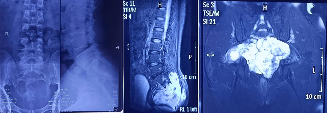 Radiological evaluation of a sacral bone tumor Radiological evaluation of a sacral bone tumor