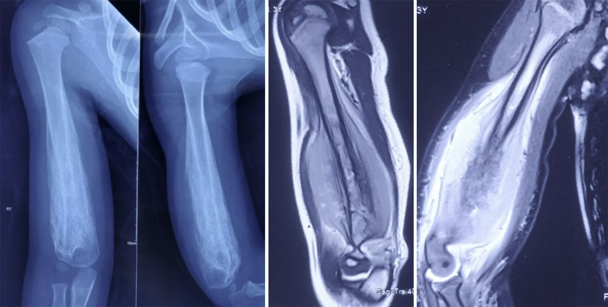 Radiological evaluation of an arm bone tumor using X-rays and MRI to assess the tumor's location, extent and involvement of surrounding tissues