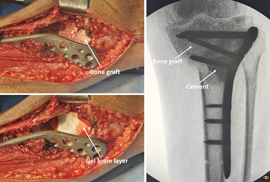 Rebuilding the bone after tumor removal Rebuilding the bone after tumor removal