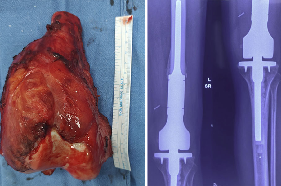 Knee endoprosthesis after giant cell tumor resection Knee endoprosthesis reconstruction following wide resection of a Grade 3 giant cell tumor of bone