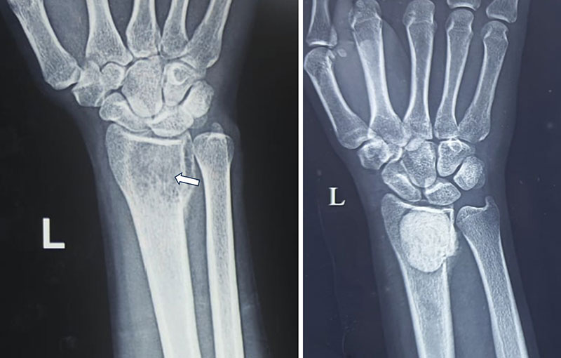 Reconstruction following curettage of a giant cell tumor Reconstruction following curettage of a giant cell tumor