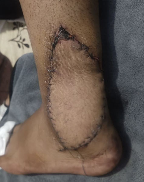Reconstruction of soft tissue defect following soft tissue sarcoma excision using free flaps Reconstruction of soft tissue defect following soft tissue sarcoma excision using free flaps