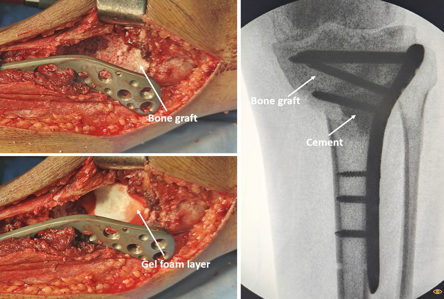 Reconstruction of the bone defect after curettage using bone cement and bone graft, secured with appropriate fixation to restore strength Reconstruction of the bone defect after curettage using bone cement and bone graft, secured with appropriate fixation to restore strength