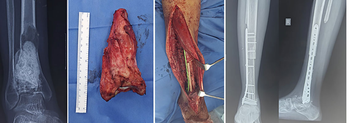 Recurrent Giant Cell Tumour Recurrent Giant Cell Tumour