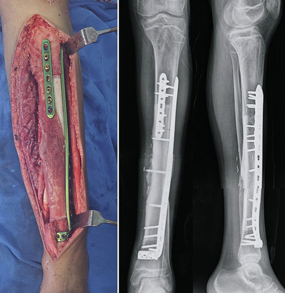 Reimplantation of the sterilized bone segment with secure fixation using metallic implants for biological reconstruction Reimplantation of the sterilized bone segment with secure fixation using metallic implants for biological reconstruction