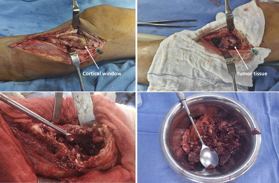 Removing the tumor from inside the bone Removing the tumor from inside the bone