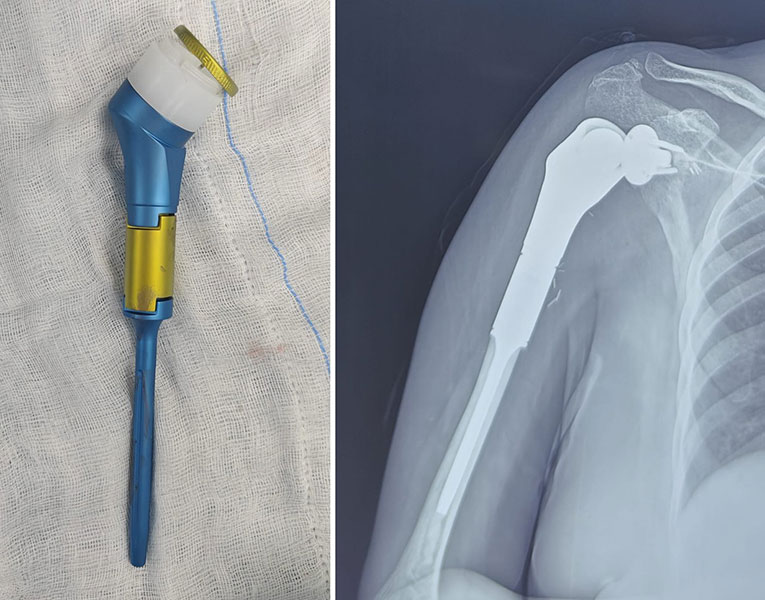 Reverse Shoulder Megaprosthesis After Limb Salvage Reverse Shoulder Megaprosthesis After Limb Salvage