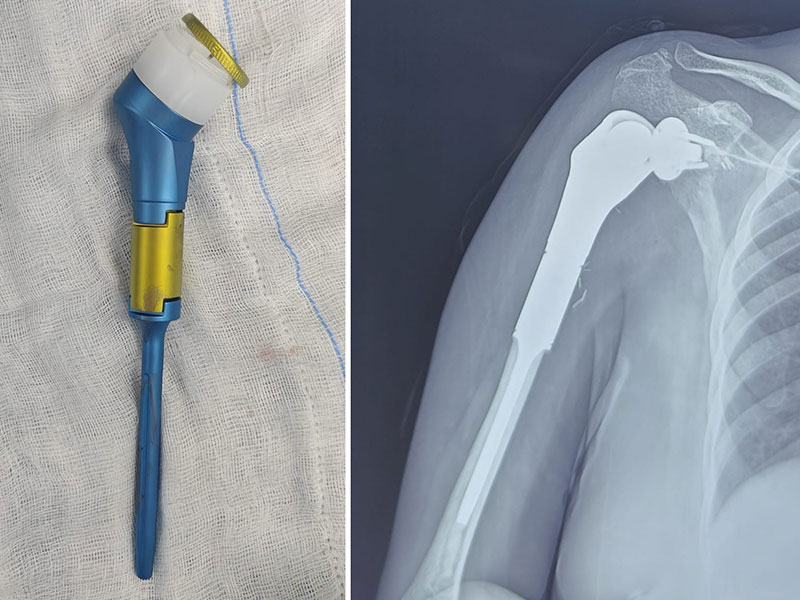 Reverse shoulder tumor prosthesis used for reconstruction after removal of a shoulder bone tumor Reverse shoulder tumor prosthesis used for reconstruction after removal of a shoulder bone tumor
