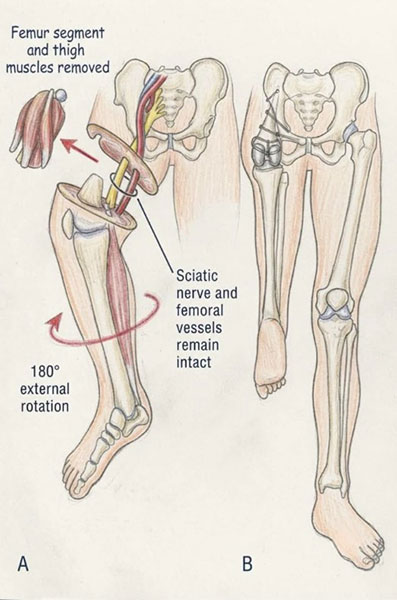 Rotationplasty after wide resection of a femoral bone tumour, with preservation of the sciatic nerve and femoral vessels