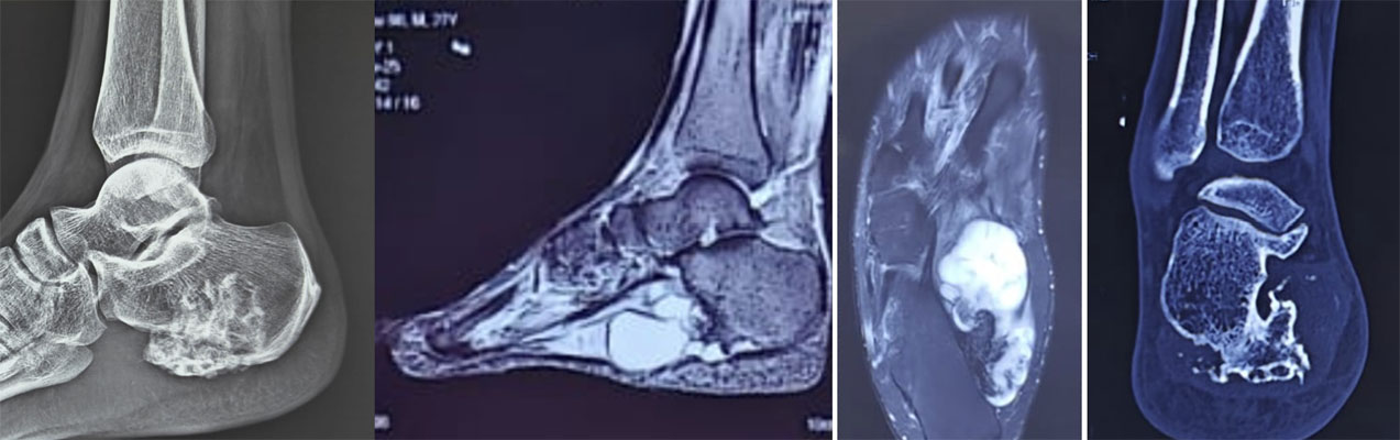 Secondary chondrosarcoma arising from osteochondroma Secondary chondrosarcoma arising from osteochondroma