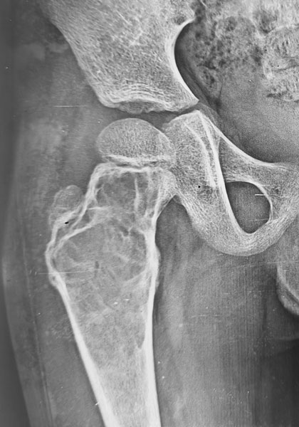 Simple (unicameral) bone cyst of the proximal femur