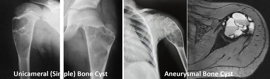 Simple and aneurysmal bone cysts Simple and aneurysmal bone cysts