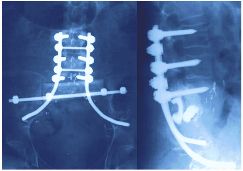 Spinal and pelvic reconstruction following sacral tumor surgery Spinal and pelvic reconstruction following sacral tumor surgery