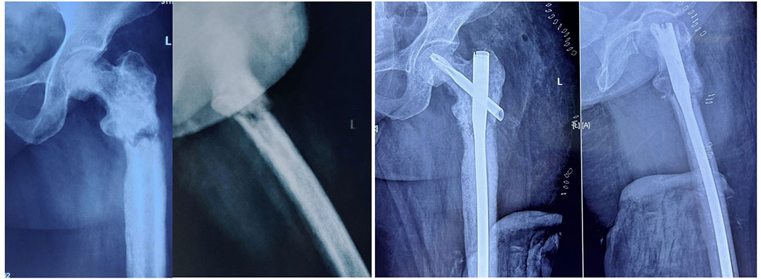 Stabilizing a pathological fracture helps restore strength and allows early movement Stabilizing a pathological fracture helps restore strength and allows early movement