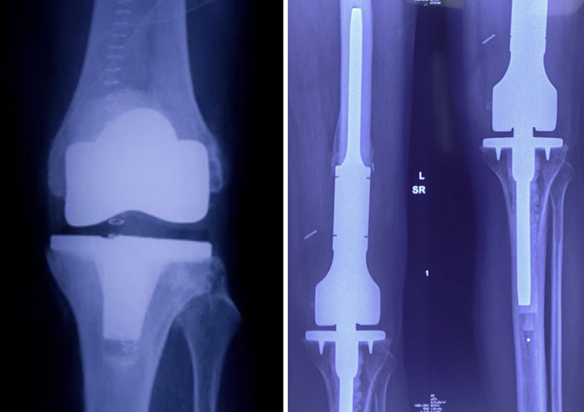 Standard Knee Replacement vs Tumor Prosthesis Standard Knee Replacement vs Tumor Prosthesis